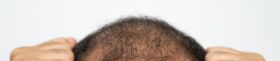 Asian man having stress cause of baldness problem. Baldness is related to your genes and male sex hormones.