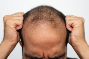 Asian man having stress cause of baldness problem. Baldness is related to your genes and male sex hormones.